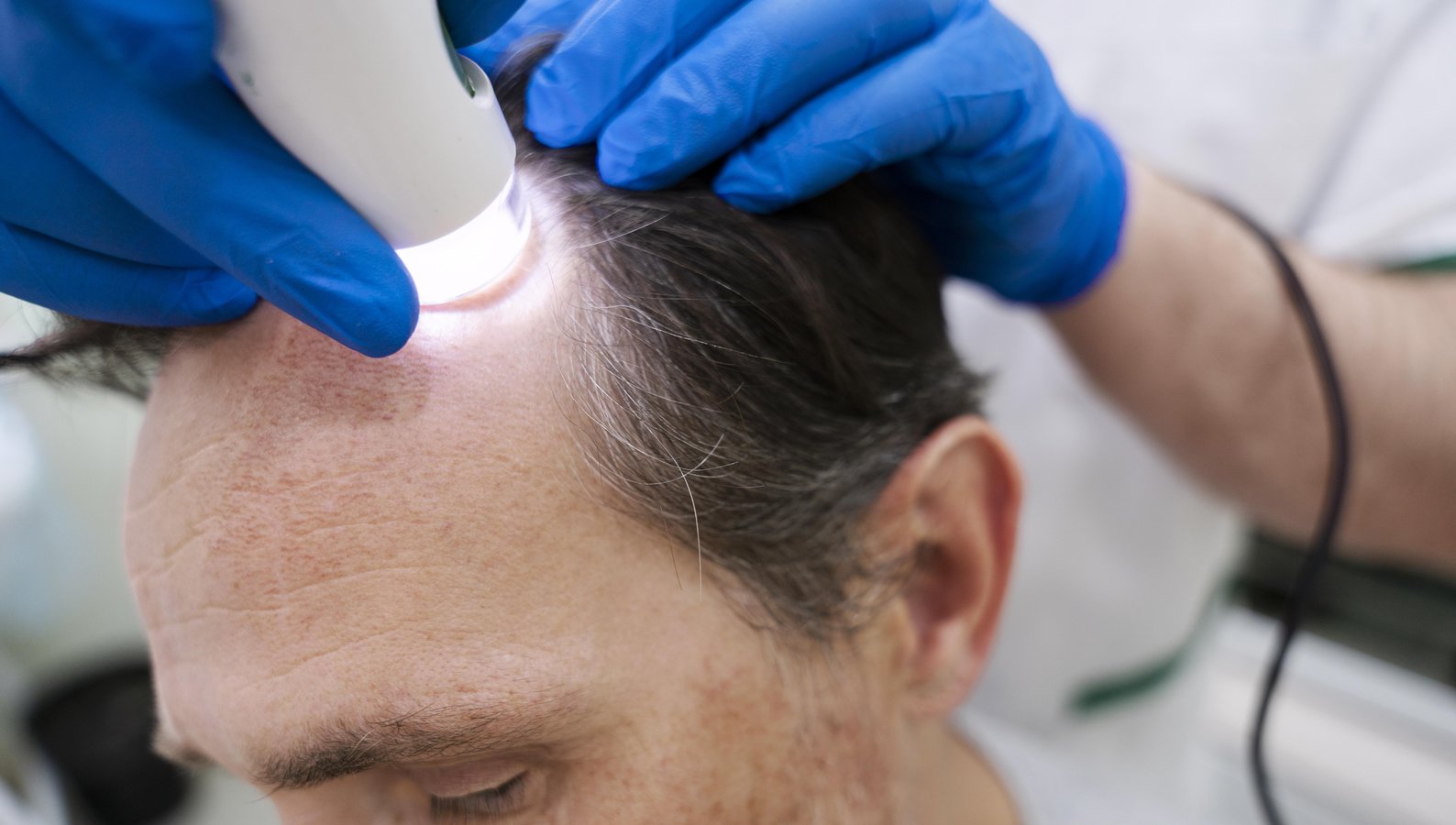 Trichoscopy scalp examination at Harrogate Hair Restoration
