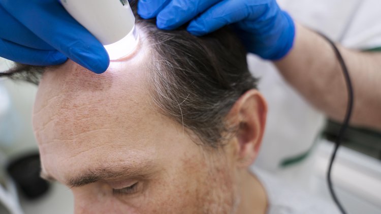 Trichoscopy scalp examination